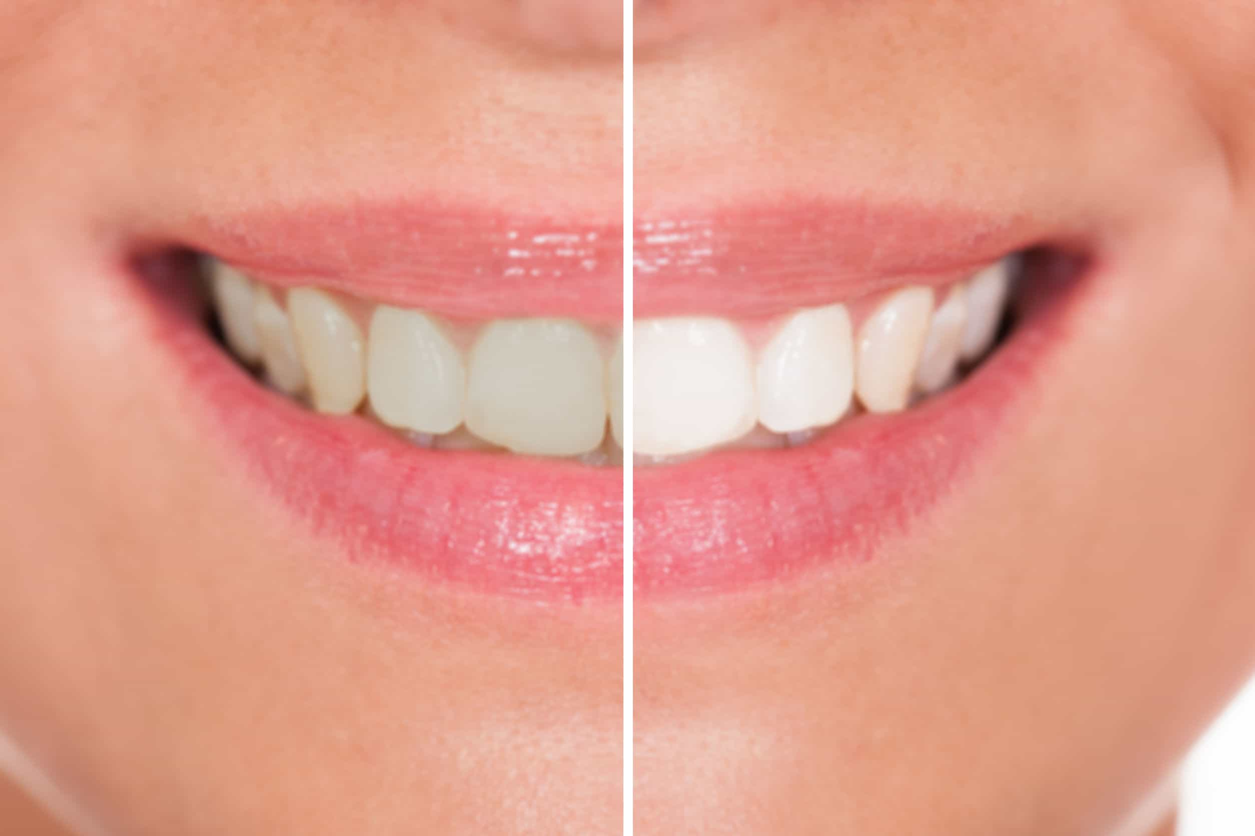 Resultado antes y después de tratamiento dental en Clínica Alvarado